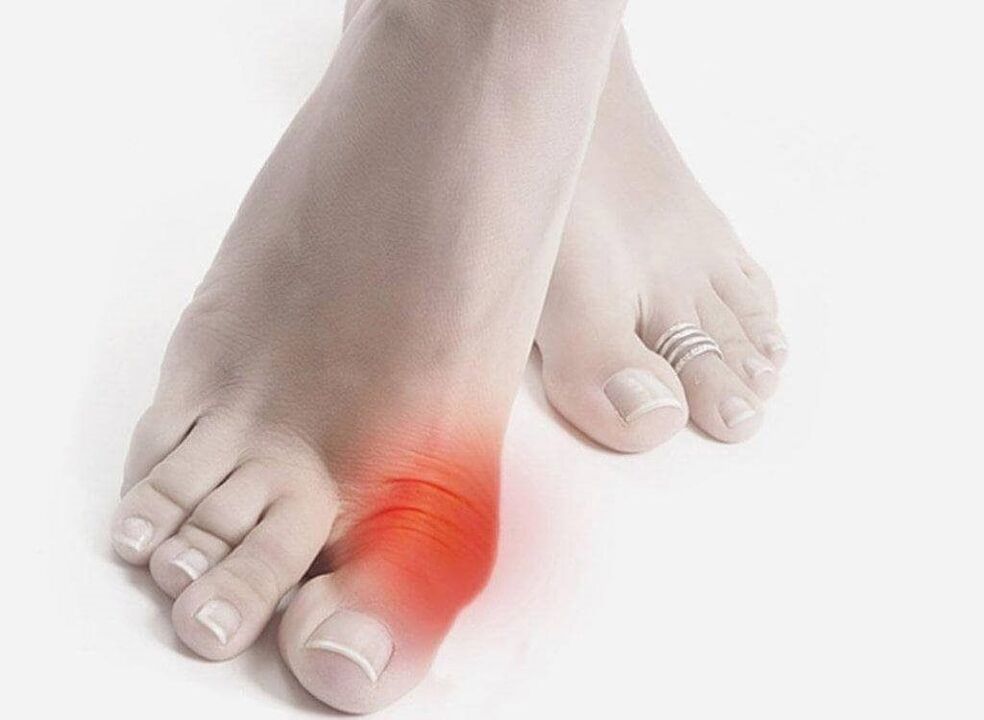 podagros pėdos simptomai